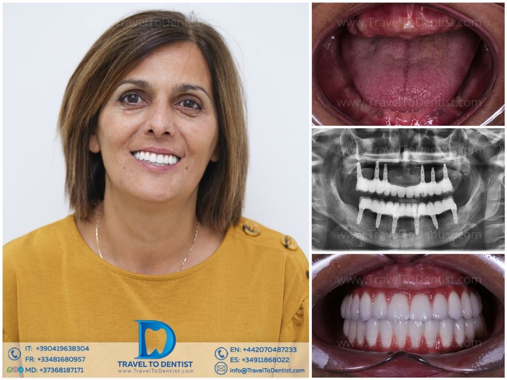 Caso clínico dental 5 — diseño de sonrisa en Dental Grisel