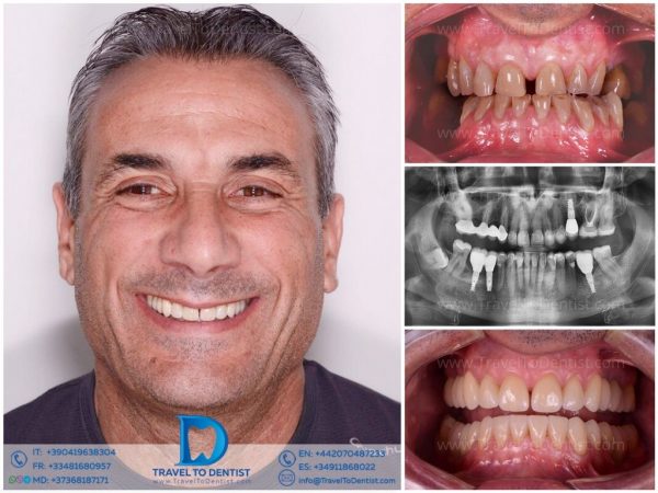 Caso clínico dental 2 — transformación de sonrisa en Dental Grisel
